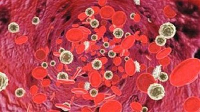 أعراض نقص الحديد، وطرق الوقاية والعلاج