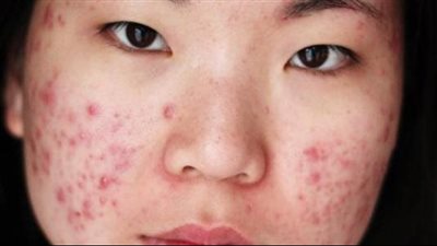 وصفة طبيعية تخفي الحبوب بالبشرة في دقائق معدودة