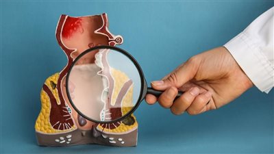 علاج البواسير الخارجية بالمنزل، ومتى نلجأ للجراحة؟