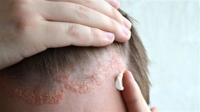  علاج الأكزيما الدهنية في المنزل وبالأدوية