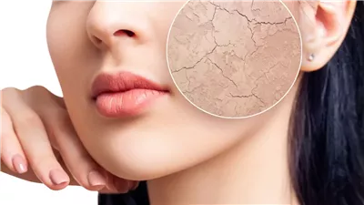 4 نصائح للحماية من تشققات الجلد في موسم الشتاء