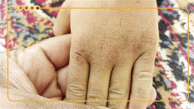 علاج جفاف الجلد في فصل الشتاء (انفوجراف)