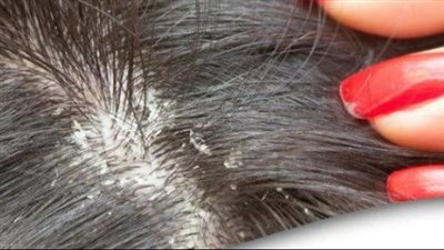  وصفة طبيعية لزيادة طول الشعر وعلاج القشرة 