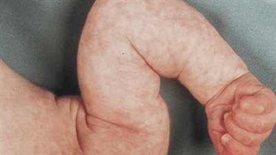 علامات إذا ظهرت على جلد طفلك حديثي الولادة يجب التنبه لها 