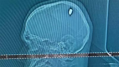  شاب برازيلي يعيش حياته بشكل طبيعي رغم استقرار رصاصة في رأسه، ما القصة