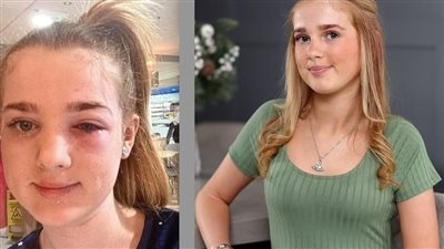 العناية الإلهية تنقذ طفلة من الإصابة بالعمى بسبب “تيك توك”