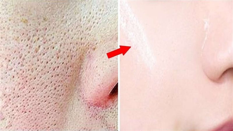 المسام الواسعة وعلاجها،