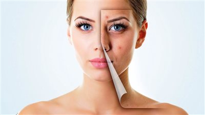 وصفات طبيعية لعلاج آثار الحبوب على البشرة