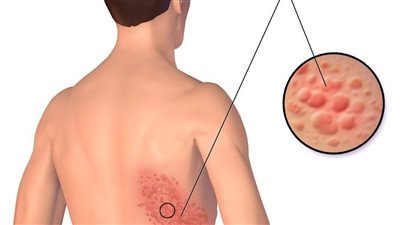 أعراض الحزام الناري، والمضاعفات وطرق العلاج