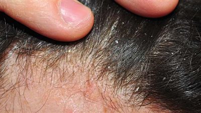 ورق السدر لشعر طويل وناعم وخال من القشرة