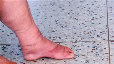 أسباب الإصابة بداء الفيل، وما هي مضاعفاته