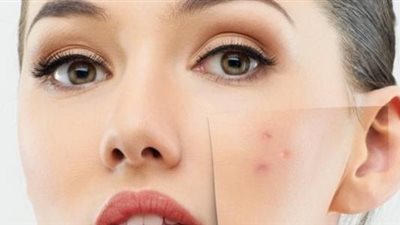 العلاجات الطبية والطبيعية لآثار حب الشباب 