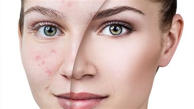 بمكونات بسيطة تخلصي من آثار الحبوب بالبشرة