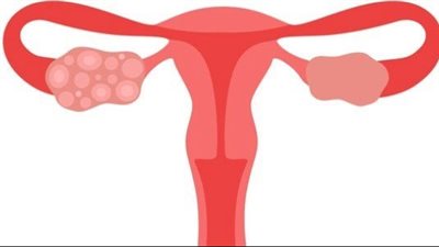 أكلات تجنبك الإصابة بتكيسات المبايض، تعرفى عليها