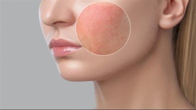  قناع الزبادي والصبار لعلاج البشرة المتهيجة