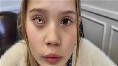 عين إلكترونية تنقذ حياة طفلة 