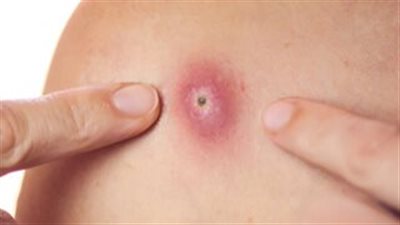 تفسير حلم الدمل في المنام وعلاقته بالتخلص من الهموم والمشاكل 