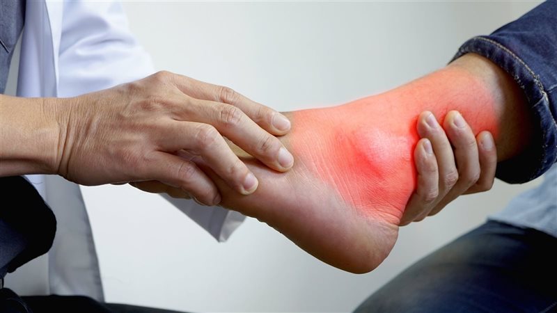 أعراض النقرس، فيتو