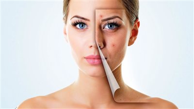 بالطمي الأخضر والقرفة، تخلصي من حبوب الوجه في أسرع وقت