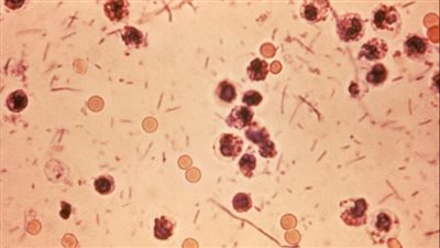 بعد ظهور إصابات في الأردن.. 8 معلومات عن عدوى الشيجيلا 