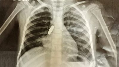 طفلة تبتلع طلقة خرطوش وملوي التخصصي تنجح في إنقاذها | صور