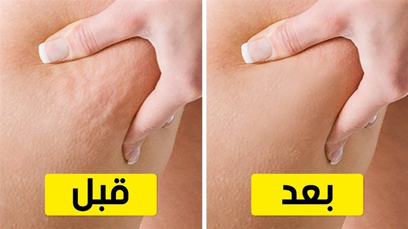 السيلوليت 