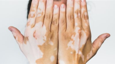 منها السكري واديسون، أسباب وأعراض مرض البهاق