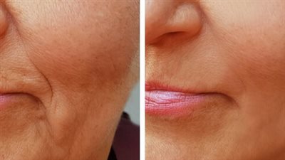 طرق تنشيط الكولاجين في البشرة، أهم الأطعمة التي تدعمه