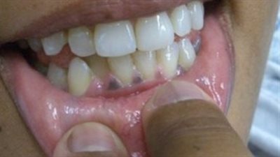 أعراض وأسباب مرض أديسون، ومتى تعد حالة طبية طارئة؟ 