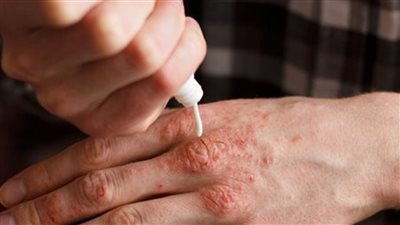  منها العدوى والإجهاد، 5 محفزات تزيد من أعراض الصدفية