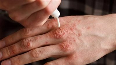  أسباب الطفح الجلدي وطرق علاجه 