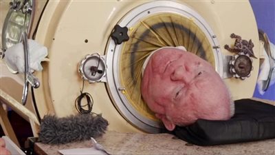 رحيل سجين الرئة الحديدية، وفاة الأمريكي بول ألكسندر عن عمر يناهز 78 عامًا