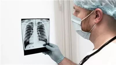 إنجاز عالمي جديد، استئصال 170 ورما خبيثا من رئتي مريض