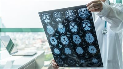 أغرب اضطراب عصبي، أمريكي يرى وجوه الآخرين مشوهة