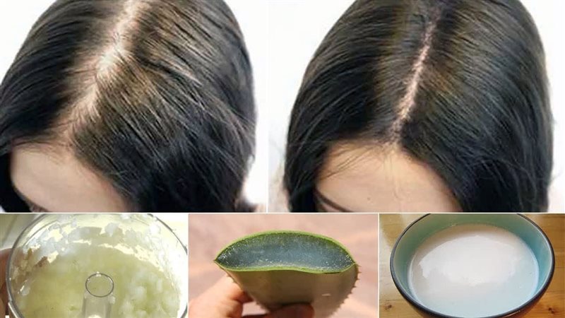 تساقط الشعر وعلاجه،