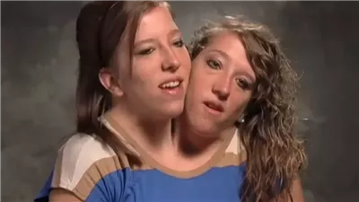  رأسان في جسد واحد، ماذا تعرف عن التوائم الملتصقة وأشهر الحالات في العالم