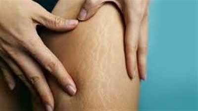 التدليك والرياضة وتقليل الملح والسكر، 3 طرق للقضاء على السيلوليت