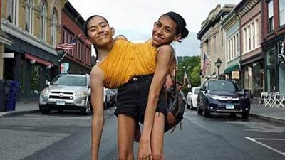 كارمن ولوبيتا، تفاصيل حساسة في حياة توأم ملتصق 