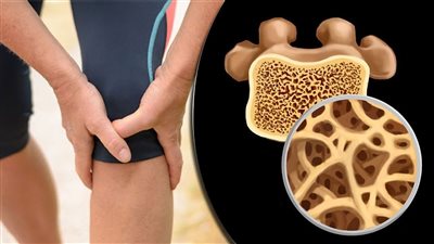 أعراض هشاشة العظام، والأسباب والعلاج وطرق الوقاية