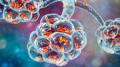 بكتيريا الإيكولاي.. حقيقة المرض الغامض بين أهالي أسوان (فيديو جراف)