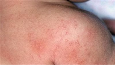 حمو النيل، الأسباب والأعراض وطرق العلاج 