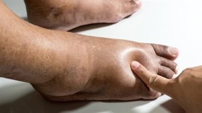 6 طرق بسيطة للتخلص من الماء الزائد بالجسم 