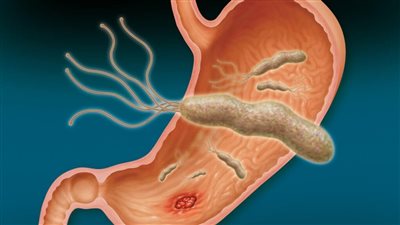 أعراض جرثومة المعدة، أسباب الإصابة وطرق الوقاية والعلاج