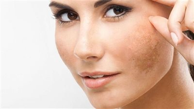 وصفة طبيعية لتفتيح المناطق الداكنة بالبشرة والجسم 