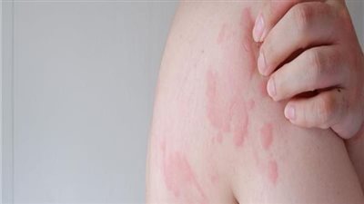 التشخيص المبكر والعلاج المناسب، مفتاح أمل لمرضى انحلال الجلد الفقاعي 