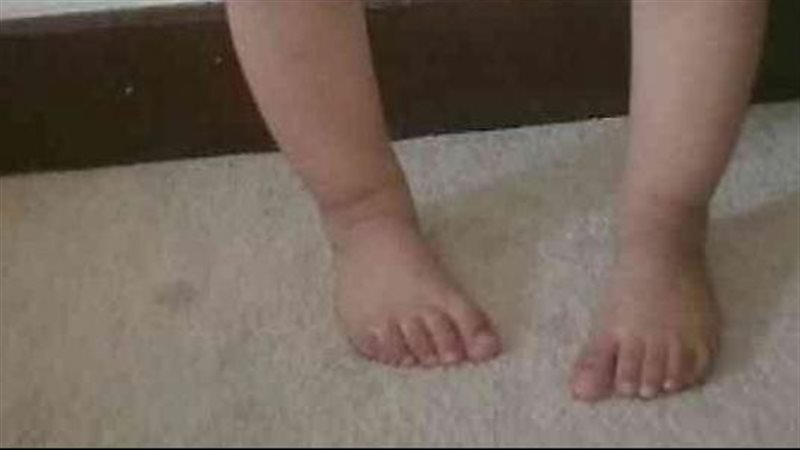 تقوس الساقين، فيتو