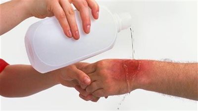 نصائح الصحة للتعامل مع إصابات الحروق ومتى يجب الذهاب للطبيب؟
