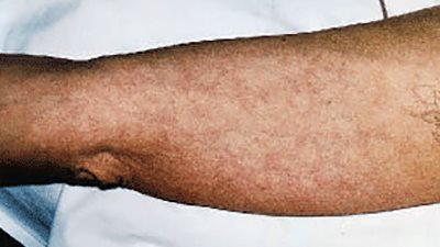 8 علامات جلدية تدل على الإصابة بأمراض القلب 