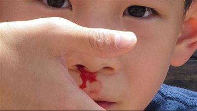 أسباب نزيف الأنف عند الأطفال فى الصيف 