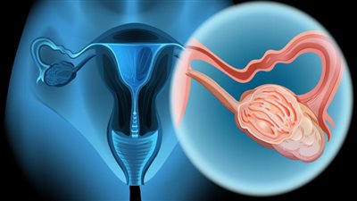 العلامات المبكرة لسرطان المبيض، والفرق بينها وبين الأكياس والكتل 